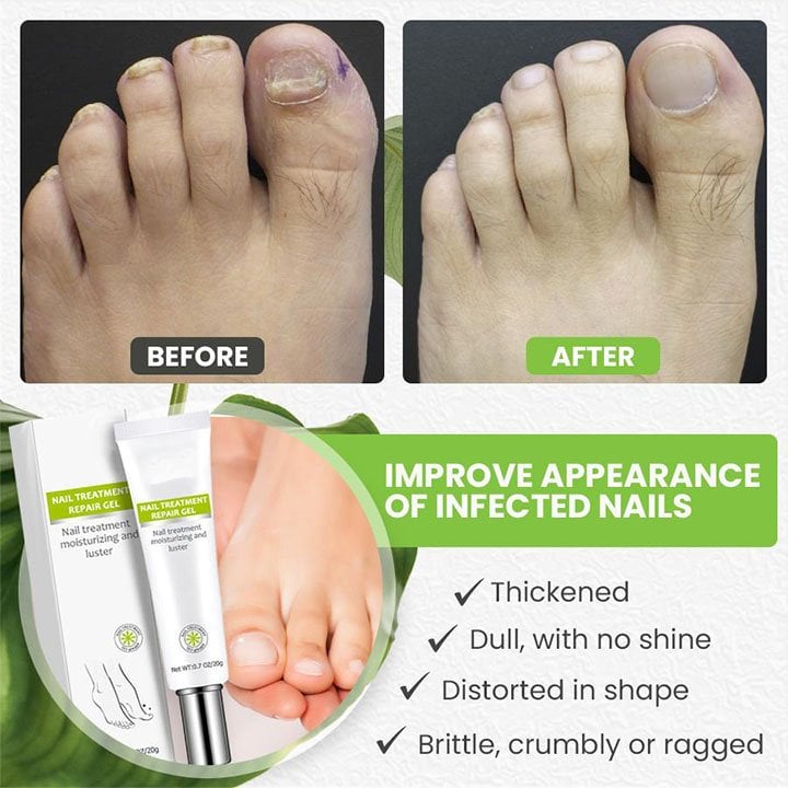 Toe-Be-Health Repair Treatment Gel