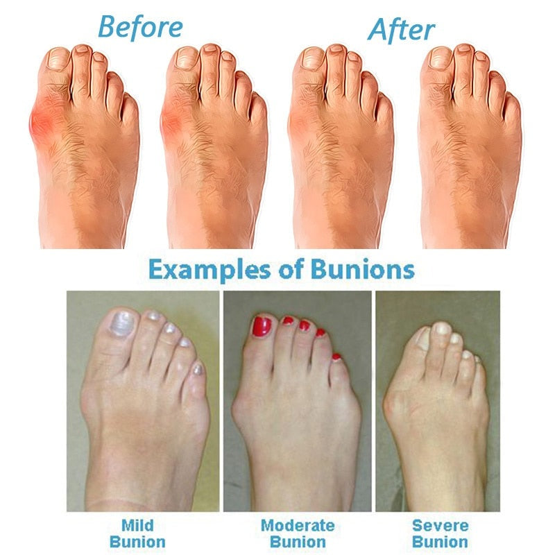 Orthopedic Bunion Corrector Sandals-🔥Last Day 75% OFF
