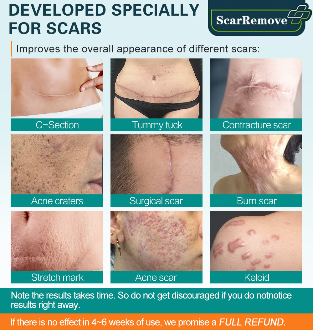 ❤️ScarRemove™ Advanced Scar Spray For All Types of Scars - Especially Acne Scars, Surgical Scars and Stretch Marks