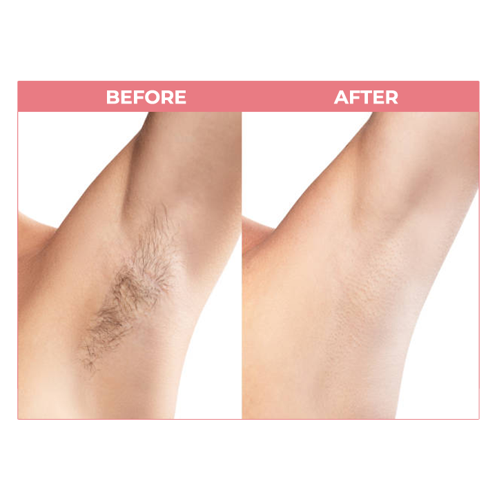 Beeswax Hair Removal (Limited Stock)