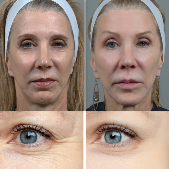 Multi-Spectral Facial Rejuvenation Device
